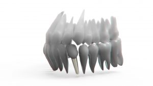 Implanty zębowe - dowiedz się więcej!