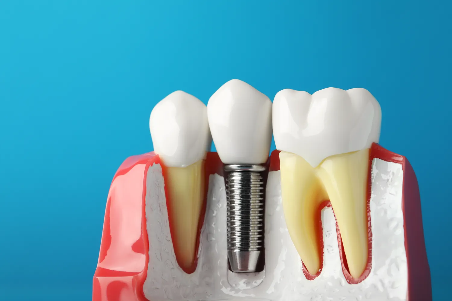 Jak się przygotować do wszczepienia implantów zębów?