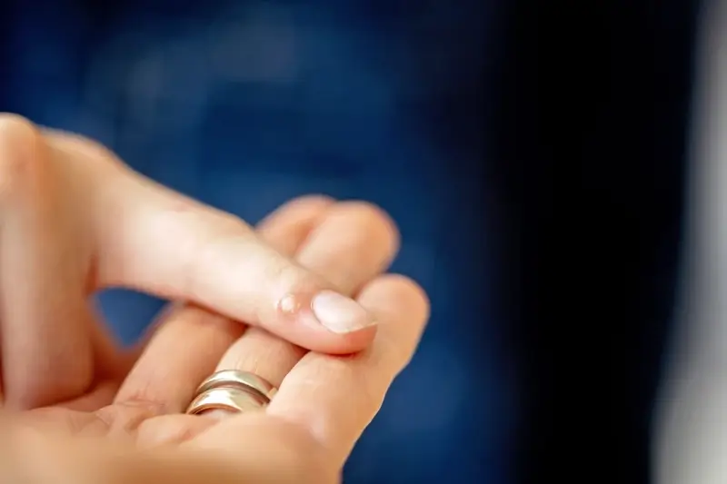 Co na kurzajki domowe sposoby?